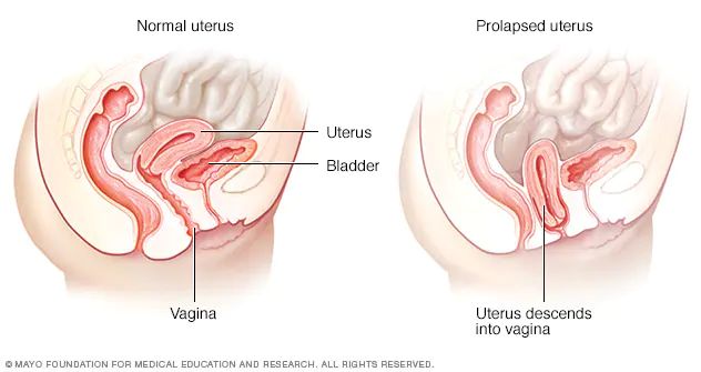 Prolapsed Uterus 健康久 Health99