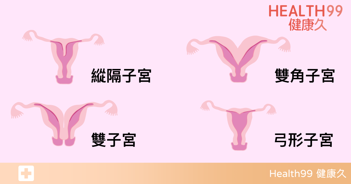 子宮畸形