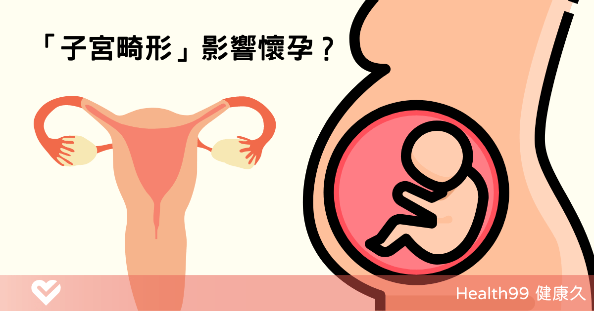 子宮畸形懷孕