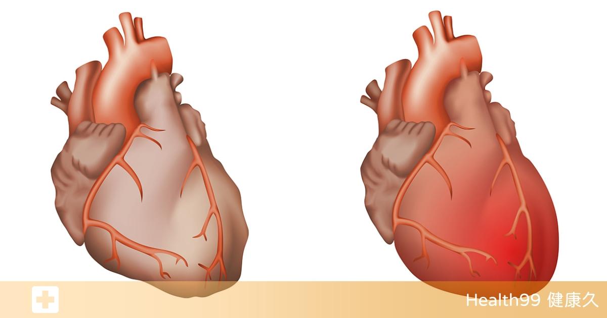 什麼是心包膜炎？心包炎的症狀表現以及預防方法