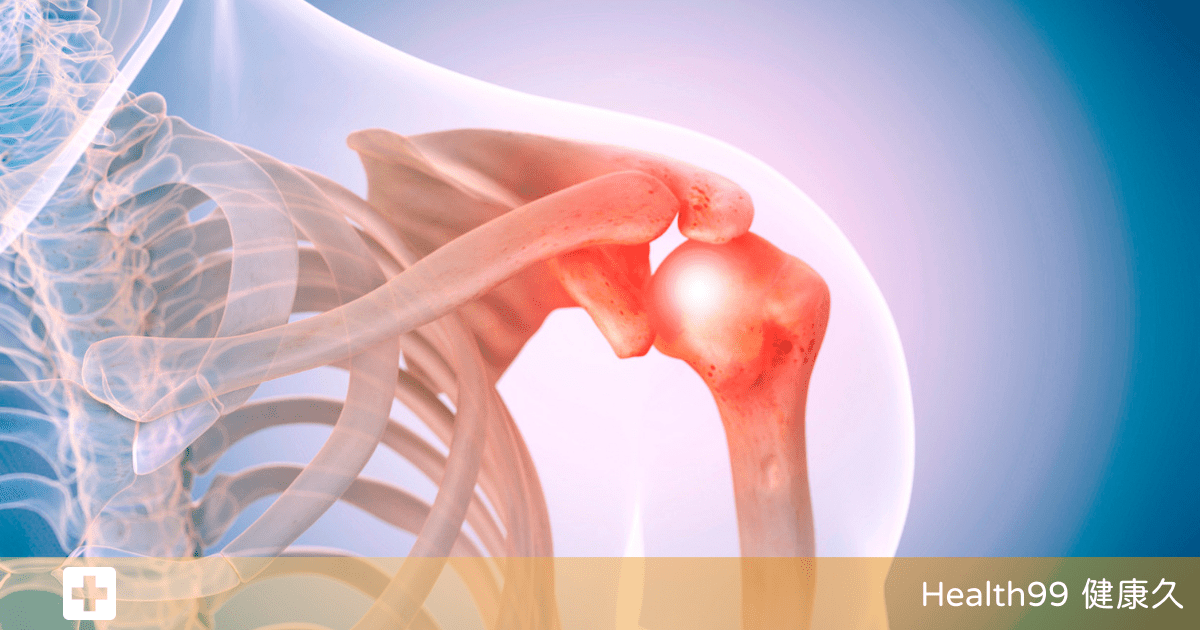 肩痛原因治療和預防方法