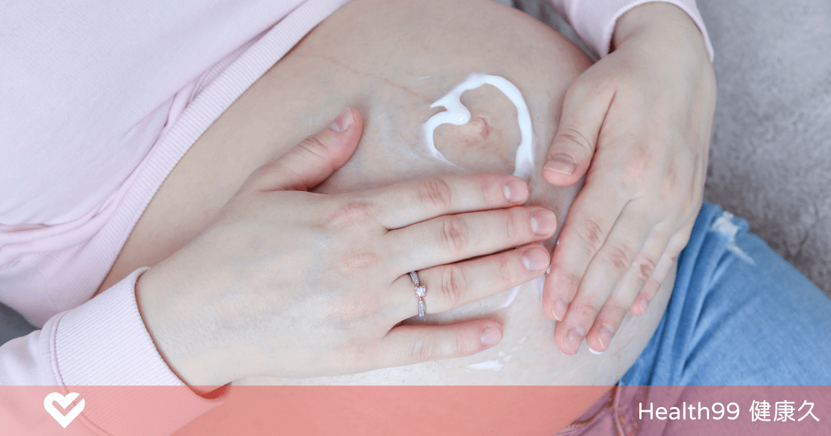 預防妊娠紋